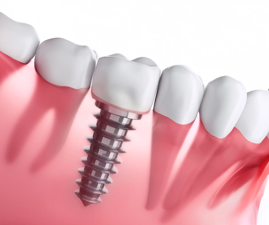 Unlocking Personalised Nutrition for Optimal Dental Implant Health