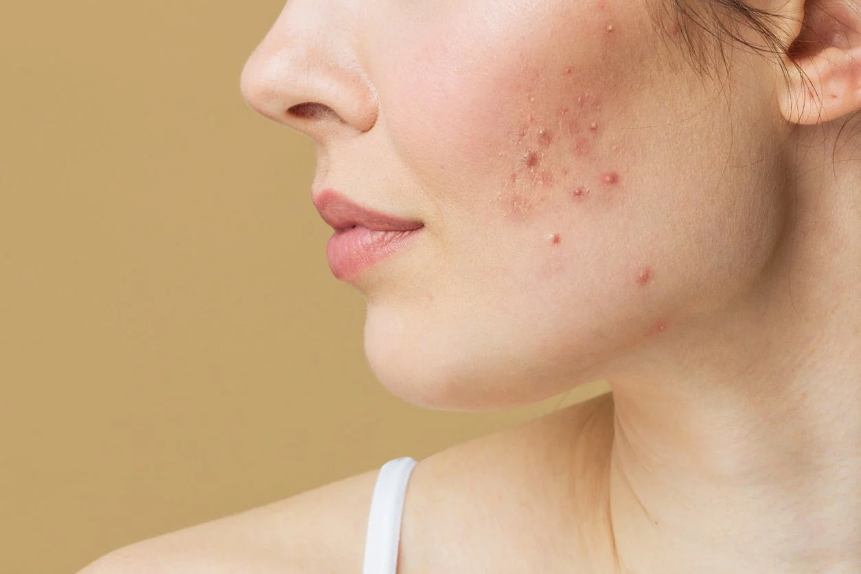 Dealing With Frequent Breakouts? A Clarifying Cleanser Can Simplify Your Routine